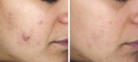 DERMACEUTIC Milk Peel Treatment Kit 奶滑果酸煥膚套盒