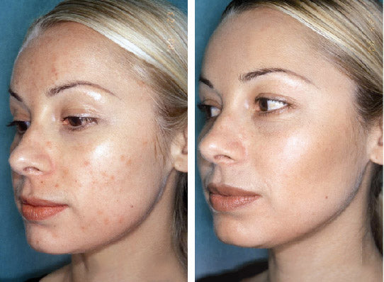 DERMACEUTIC Milk Peel Treatment Kit 奶滑果酸煥膚套盒